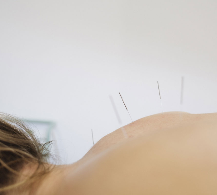 Acupuntura